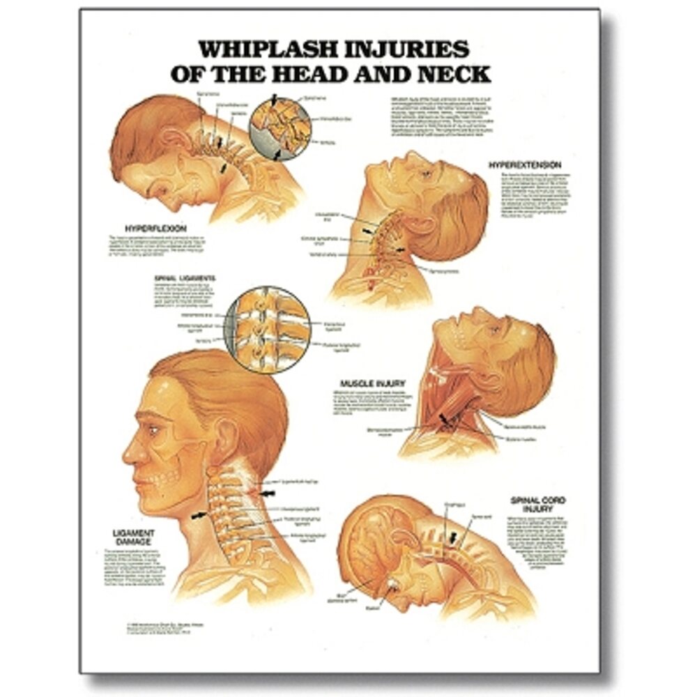 Whiplash Injuries Of Head & Neck 20